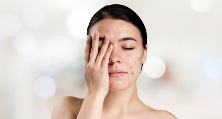 Image representing Acne Treatment Packages